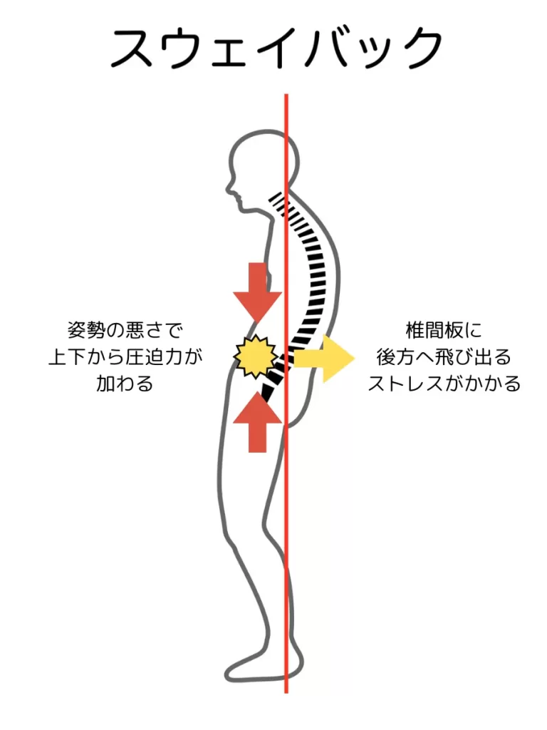 姿勢の悪さによる椎間板への圧迫でヘルニアが起こる