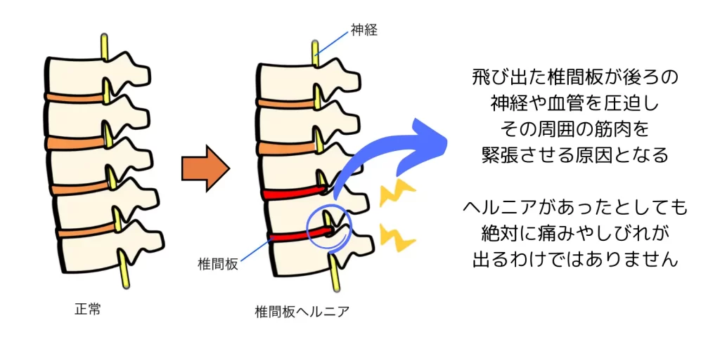 ヘルニアによる坐骨神経の圧迫の説明